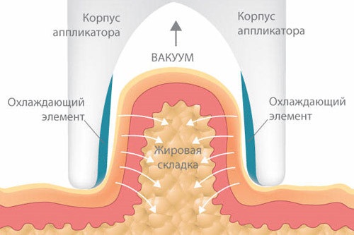 Cavitation - what it is, how fat is removed. Before and after photos