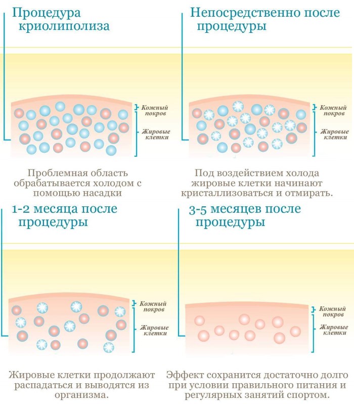 Cryolipolysis (cryoliposuction). What is it, price, reviews