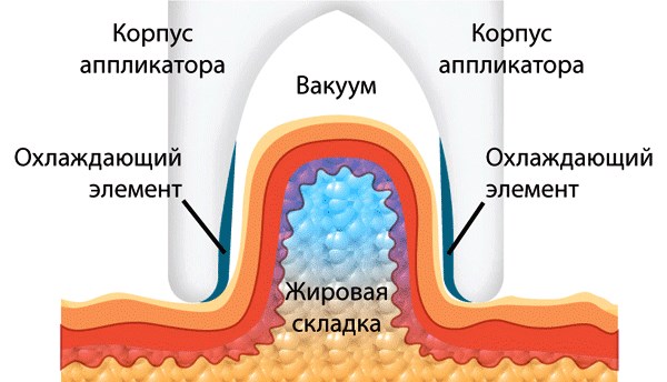 Cryolipolysis (cryoliposuction). What is it, price, reviews