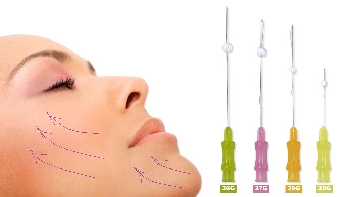 Face lifting - what is this procedure. RF-lifting, facial threads, non-surgical lifting