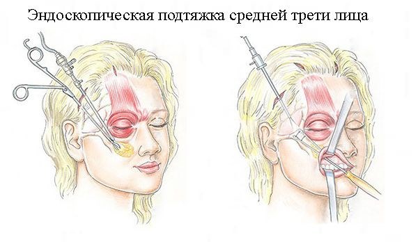 Face lifting - what is this procedure. RF-lifting, facial threads, non-surgical lifting