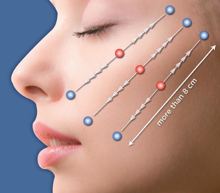 Face lifting: che cos'è questa procedura. Sollevamento RF, fili facciali, lifting non chirurgico