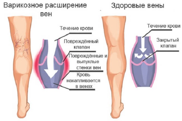 Lymphatic drainage massage. What is this procedure for losing weight, hardware, massage at home. Photo, video