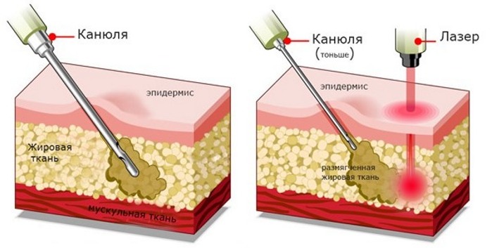 Liposuction of the abdomen - types, photos before and after, reviews