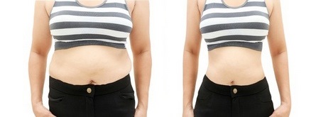 Liposuction of the abdomen - types, photos before and after, reviews