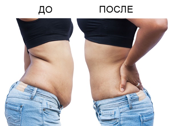 Liposuction of the abdomen - types, photos before and after, reviews