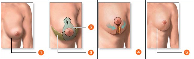 Mammoplasty - plastic surgery of the mammary glands.Photos before and after, cost, reviews