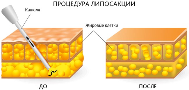 Mammoplasty - plastic surgery of the mammary glands. Photos before and after, cost, reviews