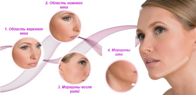 Mesothreads - lifting facelift in cosmetology. Photos, reviews, price