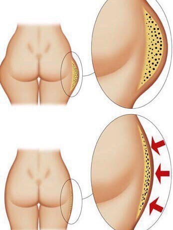 Slimming honey wrap from cellulite at home. Recipes, reviews