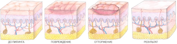 Gelbes Peeling, Retinoic - was ist das, wie macht man das zu Hause?