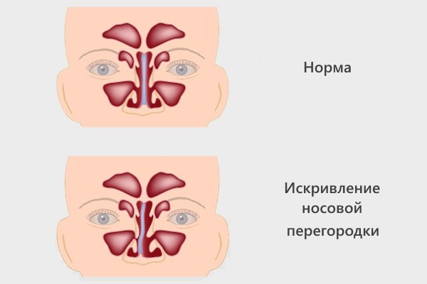 Septoplasty. What is it, nasal septum surgery, laser, indications