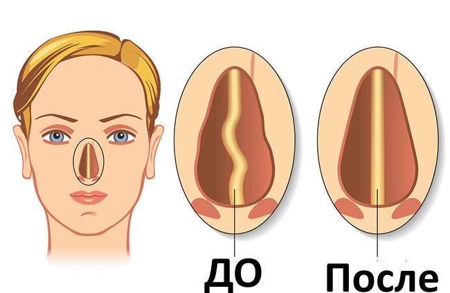 Settoplastica. Che cos'è, chirurgia del setto nasale, laser, indicazioni