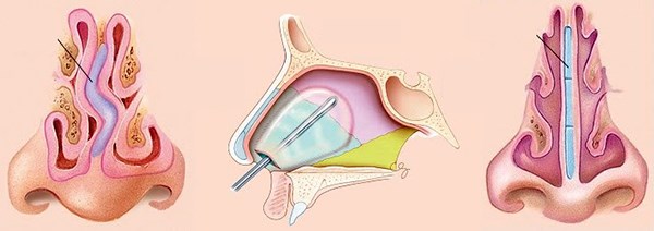 Settoplastica. Che cos'è, chirurgia del setto nasale, laser, indicazioni