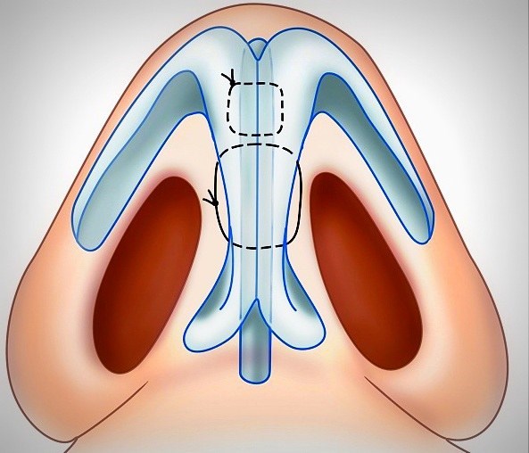 Septoplasty. What is it, nasal septum surgery, laser, indications