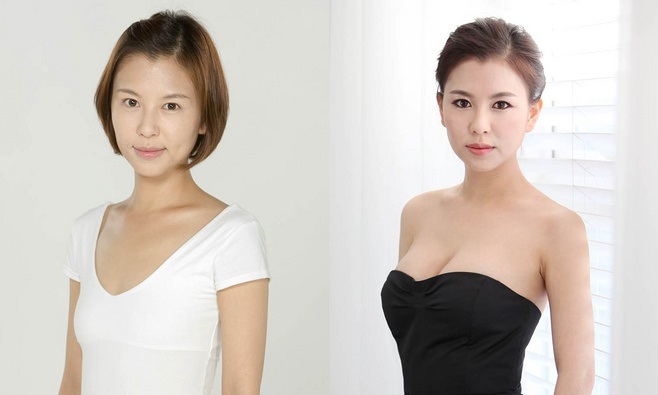 Silicone breast. Plastic surgery for breast augmentation