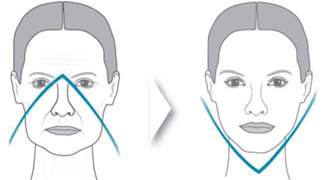 Cheekbones with hyaluronic acid. Before and after photos, cost of the procedure, reviews