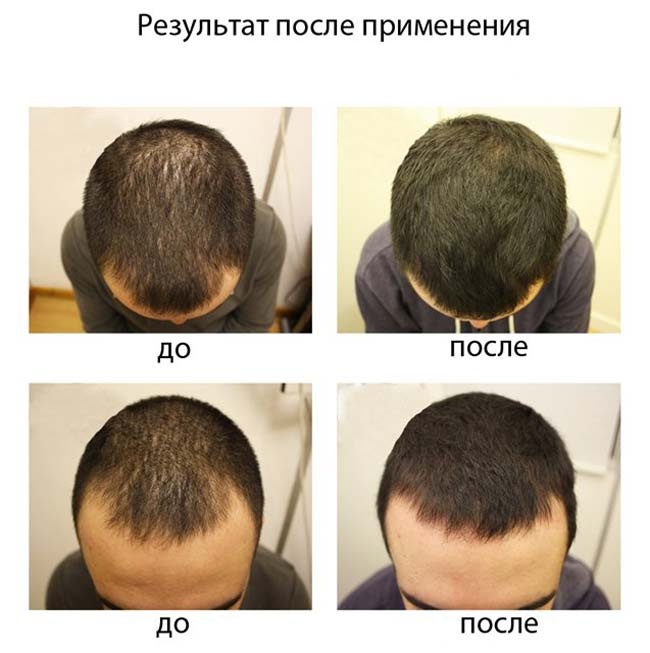 Remedy for hair loss in women and men in pharmacies