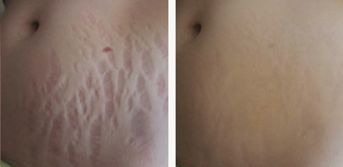 How to hide stretch marks on the stomach: with the help of procedures, tattoos, laser, photo