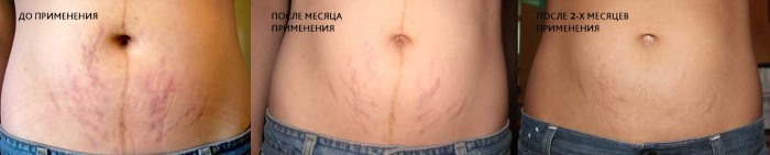 How to hide stretch marks on the stomach: with the help of procedures, tattoos, laser, photo