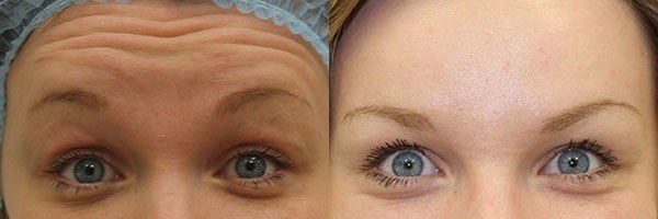 Botox injections in the forehead. Results, photos before and after, consequences, reviews