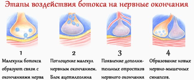 Botox injections in the forehead. Results, photos before and after, consequences, reviews