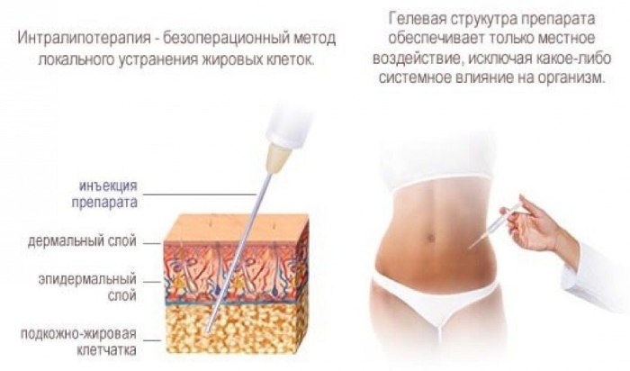 Slimming injections in the stomach. Ozone injections, lipolytics, Aqualix, reviews, prices