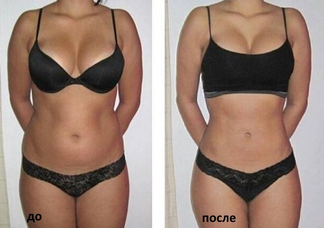 Slimming injections in the stomach. Ozone injections, lipolytics, Aqualix, reviews, prices