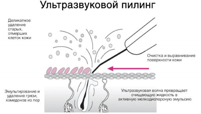 Ultrasonic face cleansing. What is it, how peeling is carried out, an apparatus for the home, photos before and after