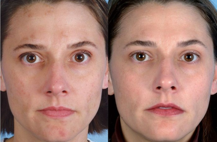 Ultrasonic face cleansing. What is it, how peeling is carried out, an apparatus for the home, photos before and after