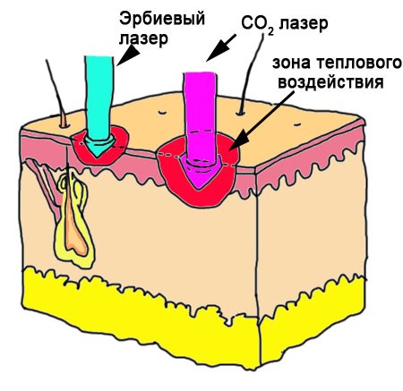 Chemical peeling for the face. What is it, how to do it at home, recipes, photos