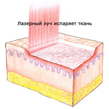 Chemical peeling for the face. What is it, how to do it at home, recipes, photos