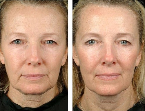 Gold threads for a facelift. What is this procedure, photo, video, price, reviews