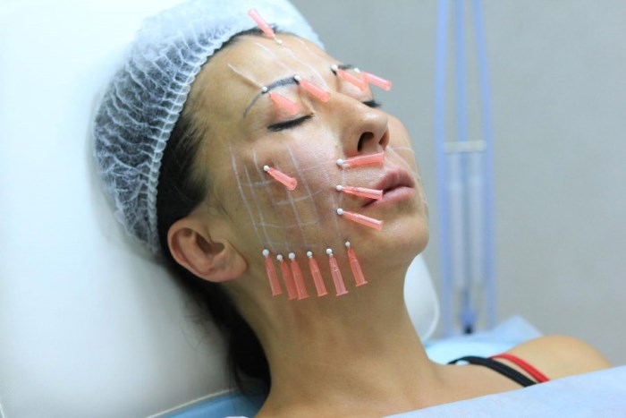 Gold threads for a facelift. What is this procedure, photo, video, price, reviews