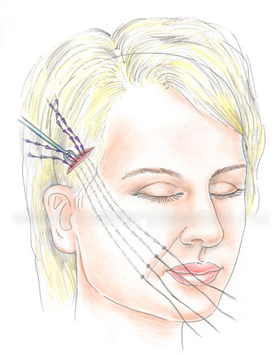 Gold threads for a facelift. What is this procedure, photo, video, price, reviews