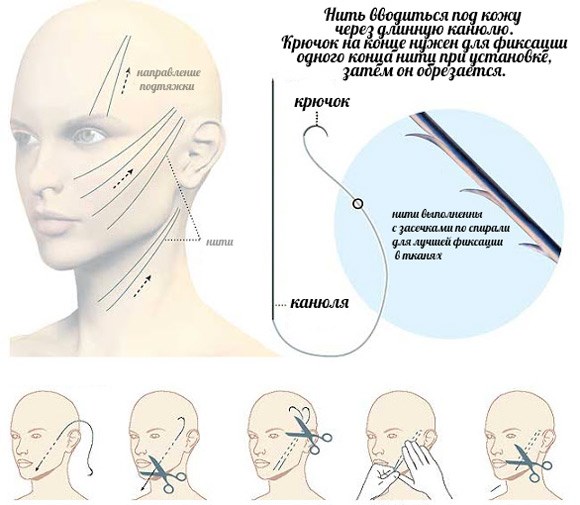 Gold threads for a facelift. What is this procedure, photo, video, price, reviews