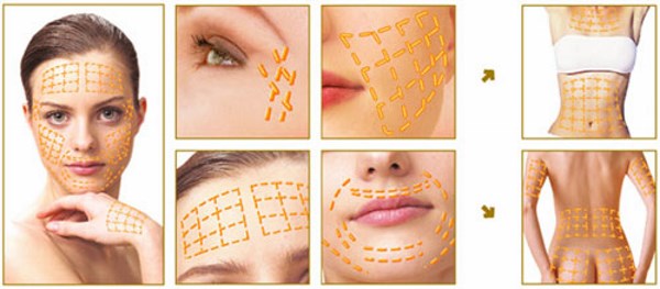 Gold threads for a facelift. What is this procedure, photo, video, price, reviews