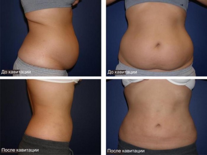 Cavitation - what it is, how fat is removed. Before and after photos