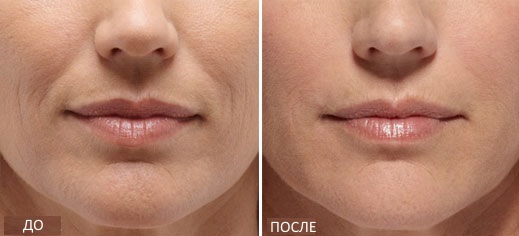 Radiesse - filler preparation for vector lifting in cosmetology