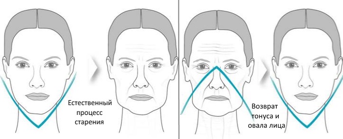 Radiesse - filler preparation for vector lifting in cosmetology