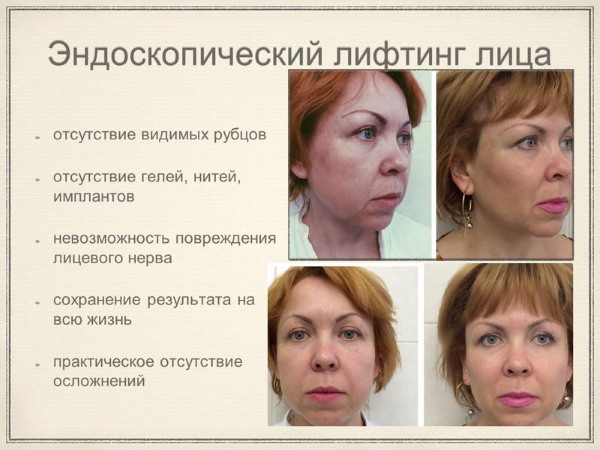 Non-surgical eyelid lift. Exercises, creams, Zhdanov lifting, skin lifting, mask at home. Reviews