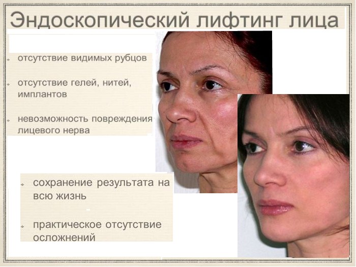 What is an endoscopic facelift