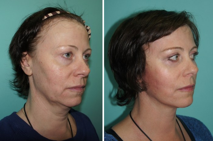 What is an endoscopic facelift