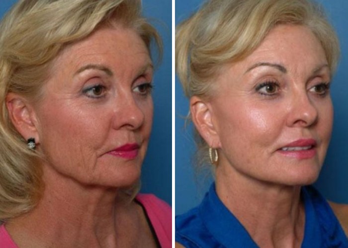 What is an endoscopic facelift