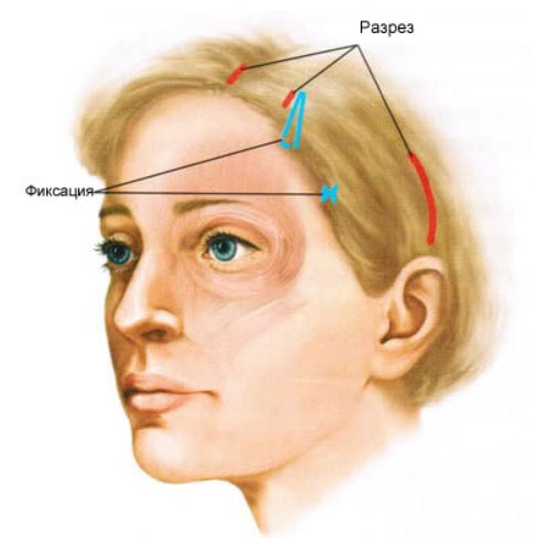 What is an endoscopic facelift