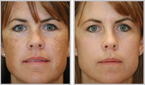 Photorejuvenation of the face and body. What is it, pros and cons, before and after photos, price