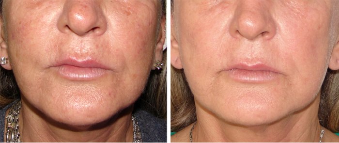 Photorejuvenation of the face and body. What is it, pros and cons, before and after photos, price