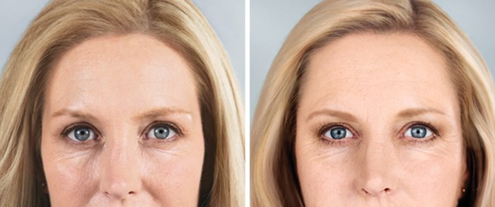 Photorejuvenation of the face and body. What is it, pros and cons, before and after photos, price