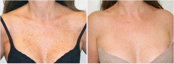 Photorejuvenation of the face and body. What is it, pros and cons, before and after photos, price