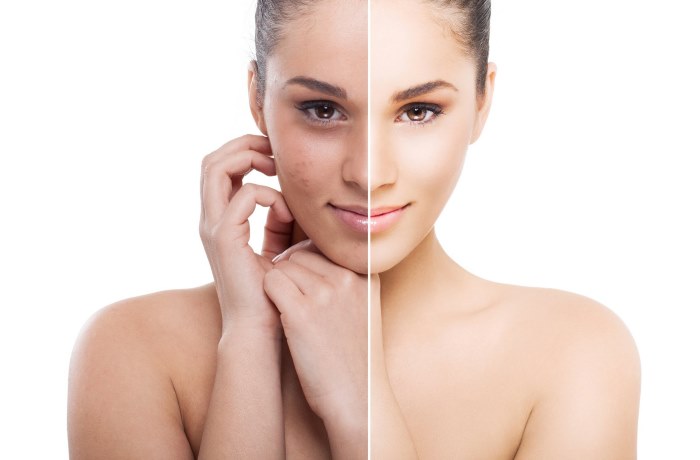 Photorejuvenation of the face and body. What is it, pros and cons, before and after photos, price